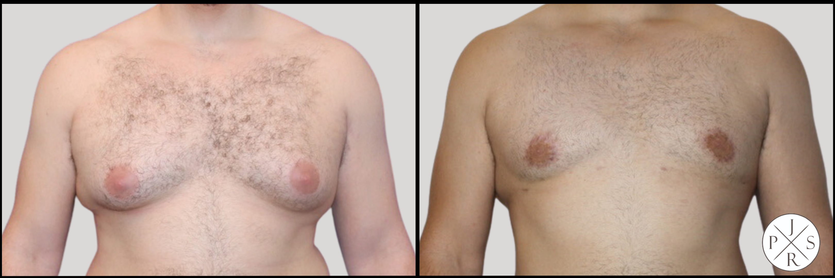 Gynecomastia Before & After Image